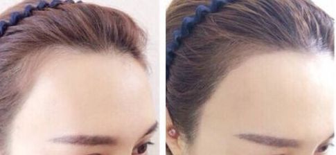 杭州疤痕整形哪家醫(yī)院好？選擇哪個(gè)醫(yī)院更靠譜？