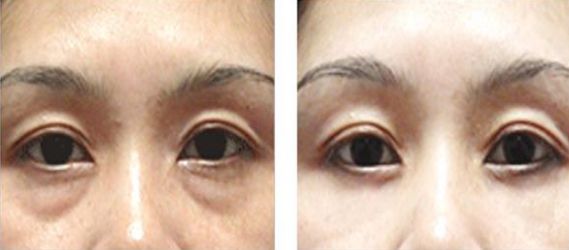 深圳哪家醫(yī)院祛色斑好-四大祛斑療法解密，選擇最適合你的祛斑方式