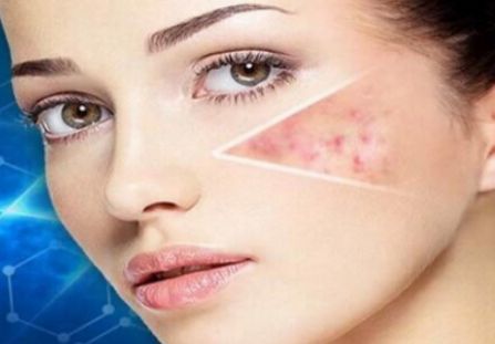 宜賓青春痘治療哪家醫(yī)院效果好？