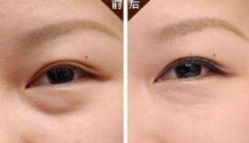 沈陽(yáng)哪家醫(yī)院做脂肪隆胸效果好且價(jià)格合理？