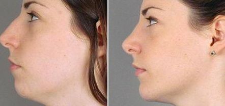 【2023邯鄲祛痘印醫(yī)院哪家好？專家推薦排行榜】