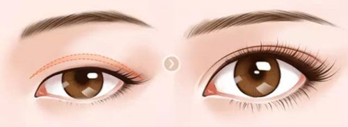 鄭州市比較好的雙眼皮整形醫(yī)生排名更新！2023年價格一覽表附錄！