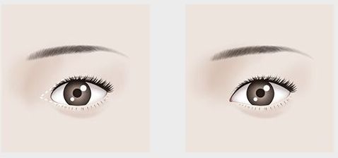 【吉林雙眼皮割的好，哪家醫(yī)院口碑最佳？】