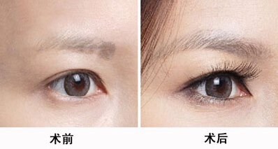 北京八大處醫(yī)院大牌醫(yī)生推薦！專治雙眼皮！