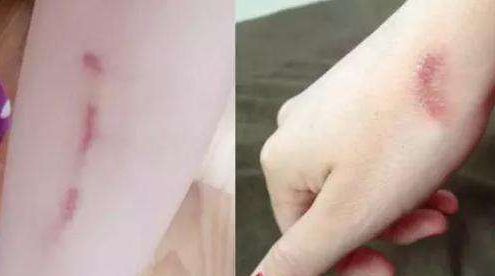 邵陽去痘去斑哪家醫(yī)院好？選擇正規(guī)醫(yī)療機構，解決邵陽去痘去斑問題