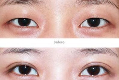 杭州開眼角醫(yī)生哪家好？專家推薦的杭州開眼角醫(yī)院排行榜