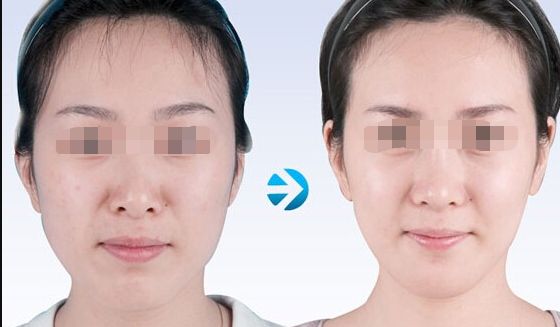 【2023北京哪家醫(yī)院做皮秒好？皮秒技術排行榜推薦】