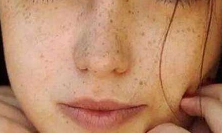 張姣姣的雙眼皮手術(shù)：術(shù)后效果如何？選擇正規(guī)醫(yī)院是關(guān)鍵！