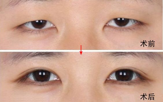 南京哪家醫(yī)院去眼袋好？眼袋手術(shù)選哪家醫(yī)院最好