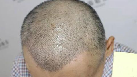 北京哪位醫(yī)生在拉皮手術(shù)方面有口碑？