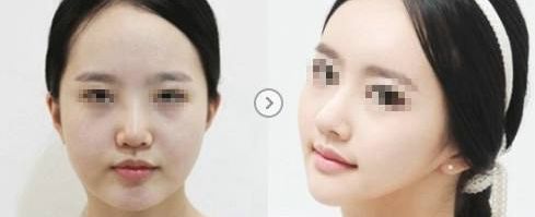 溫州哪家醫(yī)院祛除疤痕效果最佳，專家推薦！