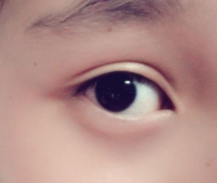 上饒祛眼袋哪家醫(yī)院好？解析上饒地區(qū)的眼袋整形醫(yī)院排名及選擇標(biāo)準(zhǔn)