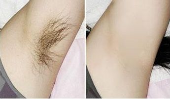 南京面吸哪家醫(yī)院效果好？解讀南京市區(qū)五家口臉部吸脂醫(yī)院的治療效果