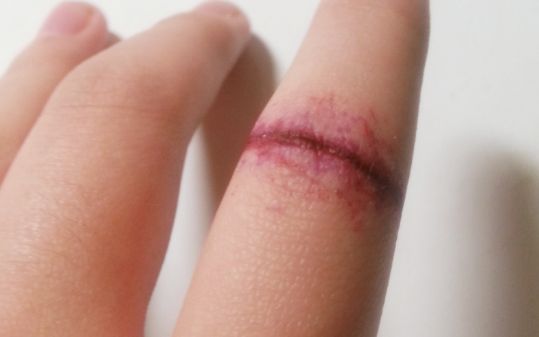 【2023無(wú)錫去眼袋最優(yōu)醫(yī)院Top5】去眼袋無(wú)錫哪家醫(yī)院好