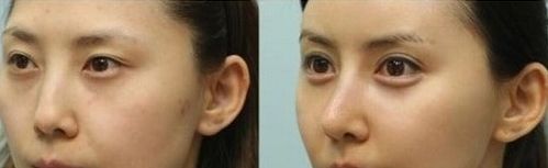 探尋上海玻尿酸隆鼻哪家好？選擇最優(yōu)質(zhì)的上海玻尿酸隆鼻機(jī)構(gòu)