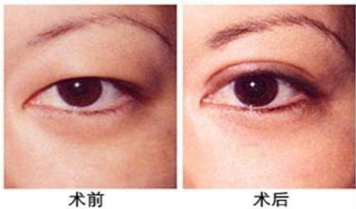 杭州做激光眼科手術哪家醫(yī)院好，專家推薦