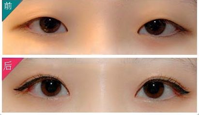 廣州哪家醫(yī)院祛眼袋效果好，專業(yè)的眼袋整形醫(yī)院推薦