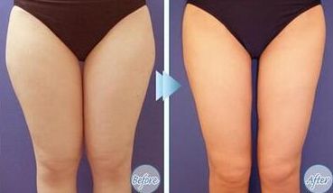 上海光澤醫(yī)院熱瑪吉效果如何？價格是多少？搭配醫(yī)生介紹一起了解