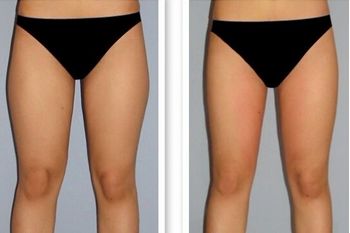 南昌哪家全科醫(yī)院有最好的外切眼袋手術(shù)效果？