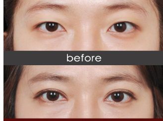 衡陽哪家醫(yī)院瘦臉針效果好且價格合理？