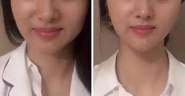 杭州激光祛斑好嗎？哪家激光祛斑的效果好？