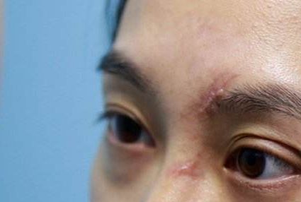 成都哪家醫(yī)院的脂肪填充臉效果好且安全？