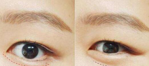 增美天使沈正宇教你打造完美鼻梁！深度揭秘示范案例，秀出新顏！