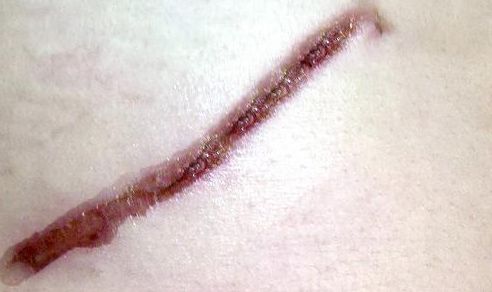 鐳射溶脂杭州哪家醫(yī)院好？專家推薦排名前三的權(quán)威醫(yī)院