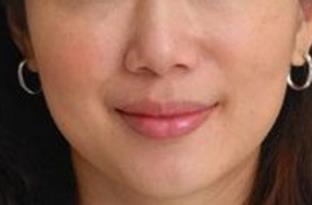 2023昆明射頻去眼底紋大型醫(yī)生(楊順新、李章麗、余海龍這些專家終于入圍了)