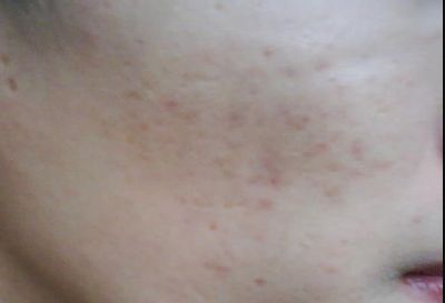 寧波祛疤哪家醫(yī)院哪里好？專家告訴你最佳選擇！