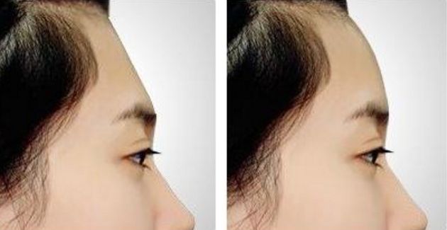 南京割雙眼皮哪家醫(yī)院效果好？