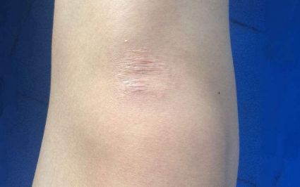 海口超聲去眼袋最佳選擇有哪些？評價最好的醫(yī)療機構(gòu)大揭秘！