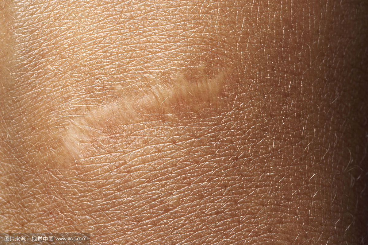 2023南昌疤痕性禿發(fā)口碑榜前10名的專家(李超、任鎮(zhèn)雄、李丹醫(yī)生技術(shù)點(diǎn)評(píng)好不好~)