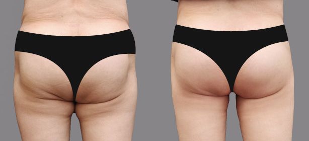 上海吸脂豐胸醫(yī)院哪家好？選擇最值得信賴的上海豐胸整形醫(yī)院