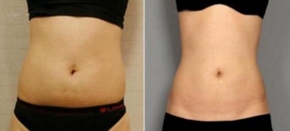 武漢玻尿酸填充效果怎么樣？哪家醫(yī)院值得選擇？