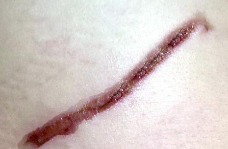 成都去法令紋哪家醫(yī)院好？找到適合你的放心醫(yī)院