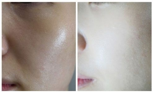 秦皇島祛斑哪家醫(yī)院好？推薦秦皇島哪家醫(yī)院祛斑效果好