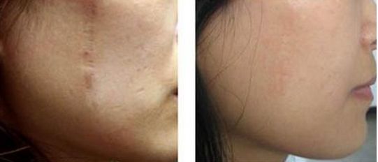 長(zhǎng)春激光祛痘，哪家好？排名靠前的專業(yè)美容機(jī)構(gòu)有哪些？