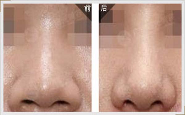 2023鄭州假體隆鼻術(shù)口碑排行前10醫(yī)生(汪金國、尹彩霞、林敬華深得人心！)