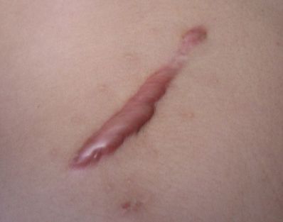 昆明哪家醫(yī)院的去眼袋手術(shù)效果好