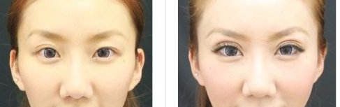 株洲哪家醫(yī)院做雙眼皮好？選擇醫(yī)院要注意這幾個關鍵點！