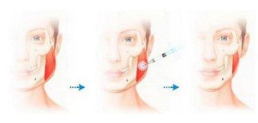 南京假體隆鼻哪家醫(yī)院效果最好？