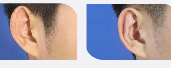 上饒哪家韓式雙眼皮醫(yī)院專業(yè)且值得信賴的推薦？