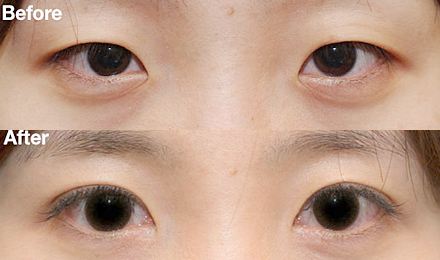 2023深圳黃金微針去除口周紋醫(yī)生綜合實力排行榜(鄭瑜璠、吳曉玲、劉彤大勢醫(yī)美重磅來襲)