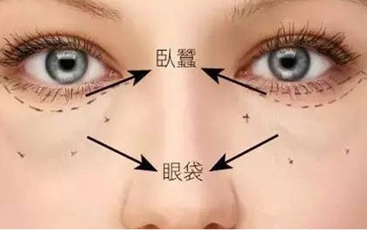 ?？谀募裔t(yī)院做眼袋效果好？