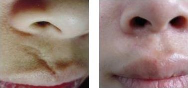 常州墊鼻梁哪家醫(yī)院好？專(zhuān)家推薦常州最受歡迎的鼻梁整形醫(yī)院