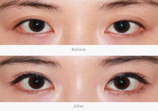 深圳哪家專業(yè)去黑眼圈機構(gòu)靠譜？