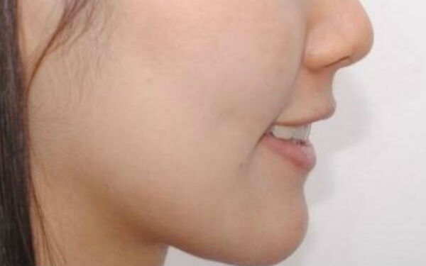 成都藝星周順波與陳遠(yuǎn)坤鼻子整形實力對決！術(shù)前比較，看誰更擅長鼻子！