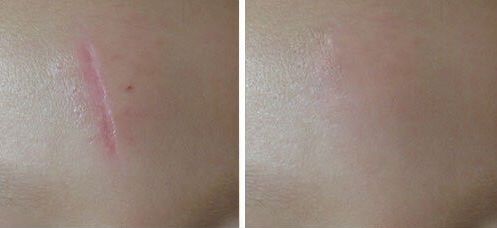 鄭州哪家醫(yī)院激光做的好？找尋專業(yè)！領先的鄭州醫(yī)院激光治療推薦