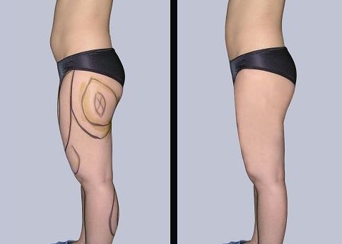 合肥哪家醫(yī)院可以有效治療腋臭問題？